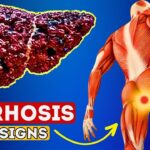 12 Early Signs Of Liver Cirrhosis | Liver Is Dying!
